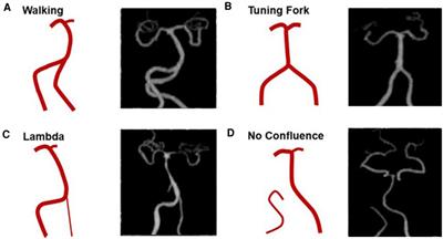 GSI CTA evaluation of the vertebrobasilar artery in normal adults at high altitude